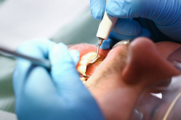 Best Knocked-Out Tooth (Avulsed Tooth) Treatment in Berea, KY